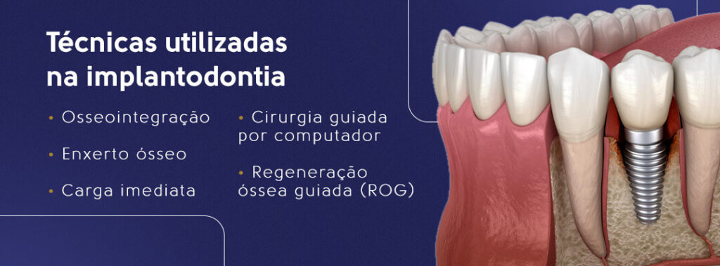 Técnicas utilizadas na implantodontia: osseointegração, enxerto ósseo, carga imediata, cirurgia guiada por computador e regeneração óssea guiada (ROG).