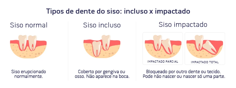 Imagem explicativa sobre os diferentes tipos de dente do siso: normal, incluso e impactado, destacando as características de cada um, como siso normal, incluso e impactado parcial e total.