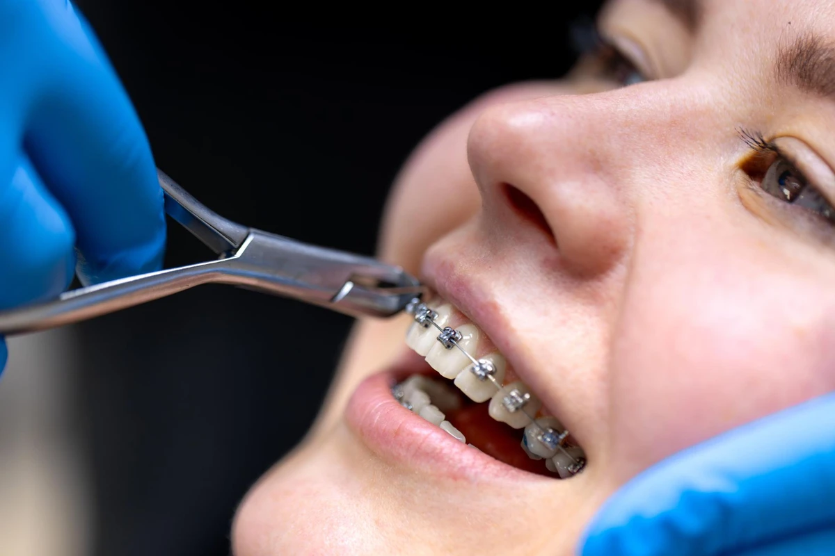Paciente sorrindo durante colocação de aparelho ortodôntico com ajuda de profissional de odontologia, mostrando os braquetes nos dentes.