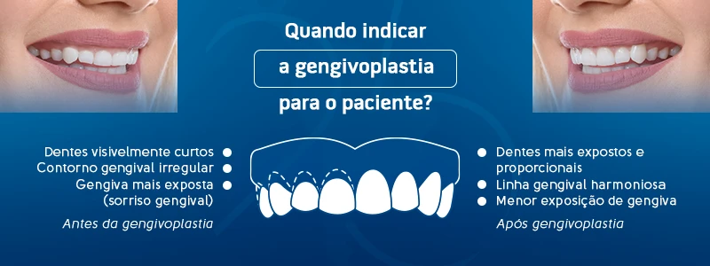 Imagem explicativa sobre gengivoplastia, mostrando antes e depois do procedimento, destacando dentes mais expostos e uma linha gengival mais harmoniosa para melhorar a estética dental.